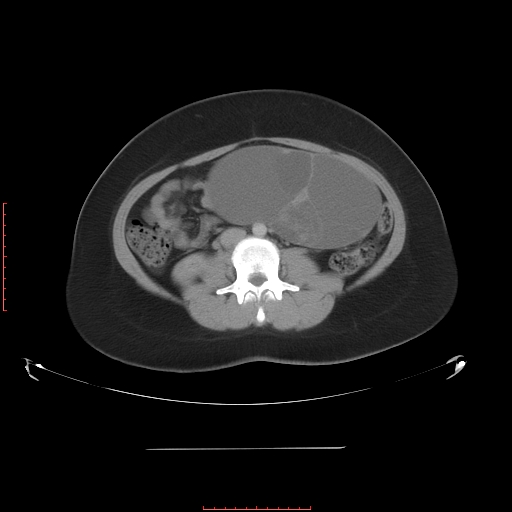 File:Bilateral ovarian serous cystadenocarcinoma with right ovarian torsion (Radiopaedia 32640-33611 A 22).jpg
