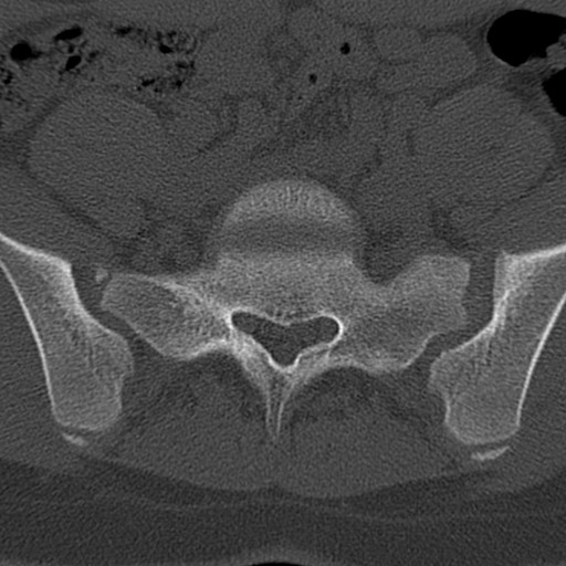 Bilateral pars defect (Radiopaedia 26691-26846 Axial bone window 75).jpg