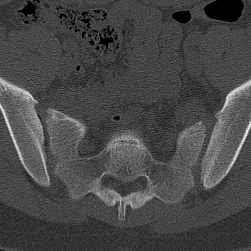 Bilateral pars defect (Radiopaedia 26691-26846 Axial bone window 99).jpg
