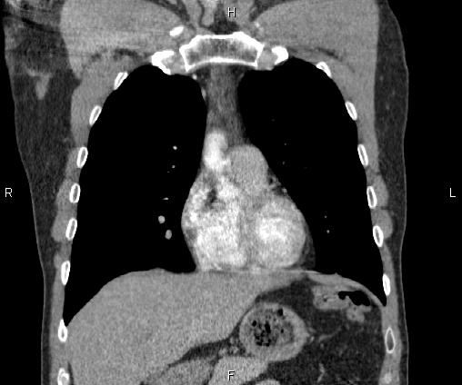 Bilateral pulmonary AVM (Radiopaedia 83134-97505 C 26).jpg