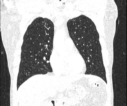 Bilateral pulmonary AVM (Radiopaedia 83134-97505 Coronal lung window 33).jpg