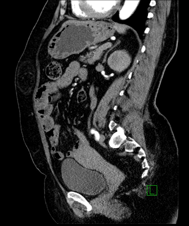 Bilateral sporadic synchronous clear cell renal cell carcinoma (Radiopaedia 85035-100575 E 54).jpg
