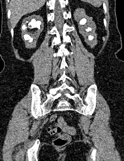 Bilateral staghorn calculi (Radiopaedia 59475-66842 Coronal non-contrast 78).jpg