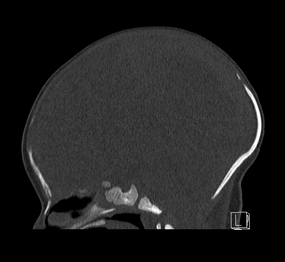 Bilateral subdural hemorrhage and parietal skull fracture (Radiopaedia 26058-26192 Sagittal bone window 48).png