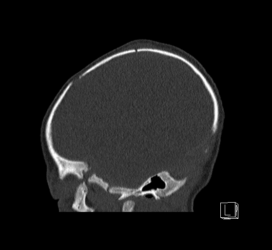Bilateral subdural hemorrhage and parietal skull fracture (Radiopaedia 26058-26192 Sagittal bone window 79).png