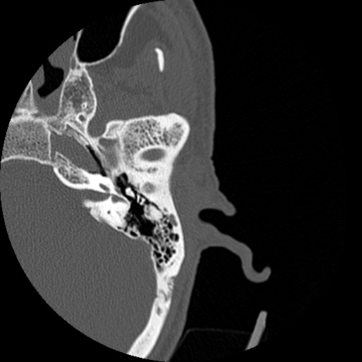 Bilateral temporal bone fractures (Radiopaedia 29482-29970 D 82).jpg