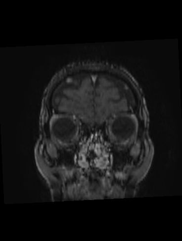 File:Bilateral thalamic glioma (Radiopaedia 65852-75009 Coronal T1 C+ 1).jpg