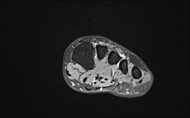 Bipartite hallux sesamoid diastasis (Radiopaedia 77133-89109 Coronal T2 fat sat 10).jpg