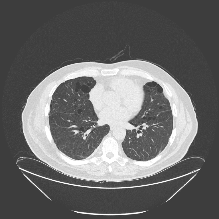 Birt-Hogg-Dubé syndrome (Radiopaedia 52578-58491 Axial lung window 37).jpg