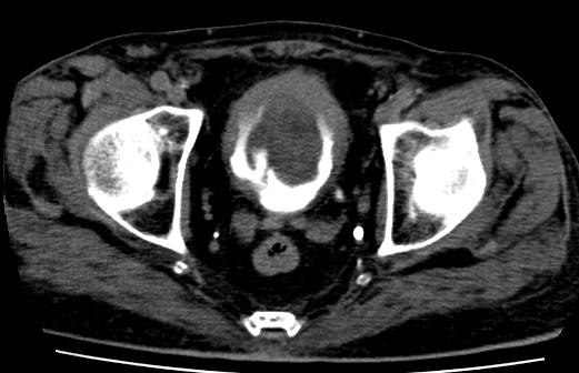 File:Bladder carcinoma (Radiopaedia 15813-15458 D 1).JPG