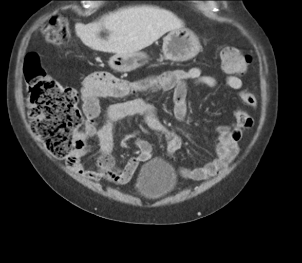 File:Bladder papillary urothelial carcinoma (Radiopaedia 48119-52951 C 19).png