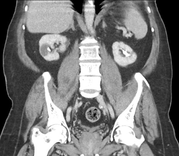 Bladder papillary urothelial carcinoma (Radiopaedia 48119-52951 C 43).png