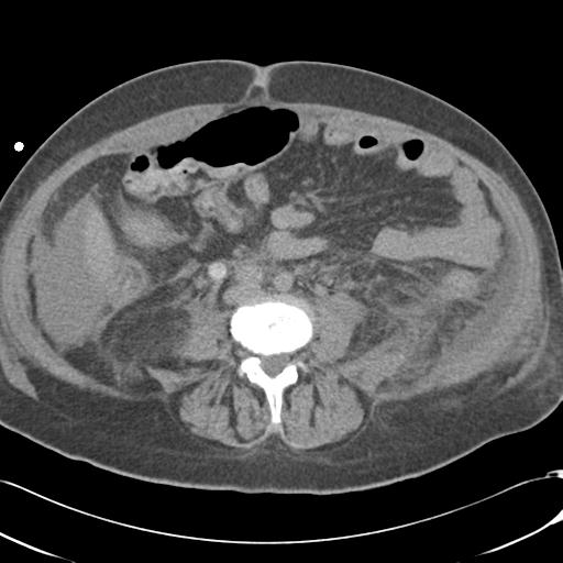 Bladder rupture post renal biopsy (Radiopaedia 30863-31572 Axial non-contrast 50).jpg