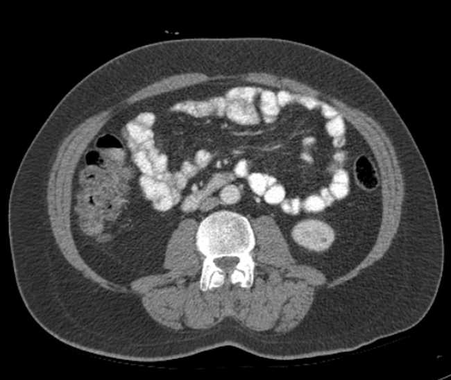 Bleeding duodenal ulcer and adenomyomatosis of gallbladder (Radiopaedia 61834-69861 A 68).jpg
