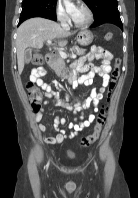 Bleeding duodenal ulcer and adenomyomatosis of gallbladder (Radiopaedia 61834-69861 B 53).jpg