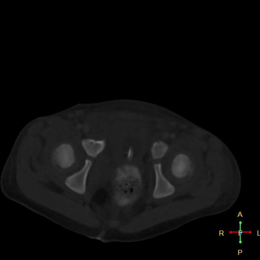 File:Blunt abdominal trauma (Radiopaedia 24780-25044 Axial bone window 17).jpg
