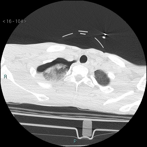 Blunt chest trauma (Swiss cheese sign) (Radiopaedia 38519-40618 Axial lung window 4).jpg