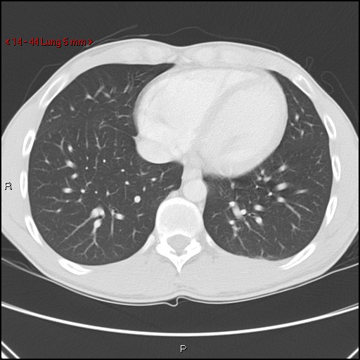 Blunt chest trauma - pulmonary interstitial emphysema and pneumomediastinum (Radiopaedia 20666-20552 Axial lung window 44).jpg