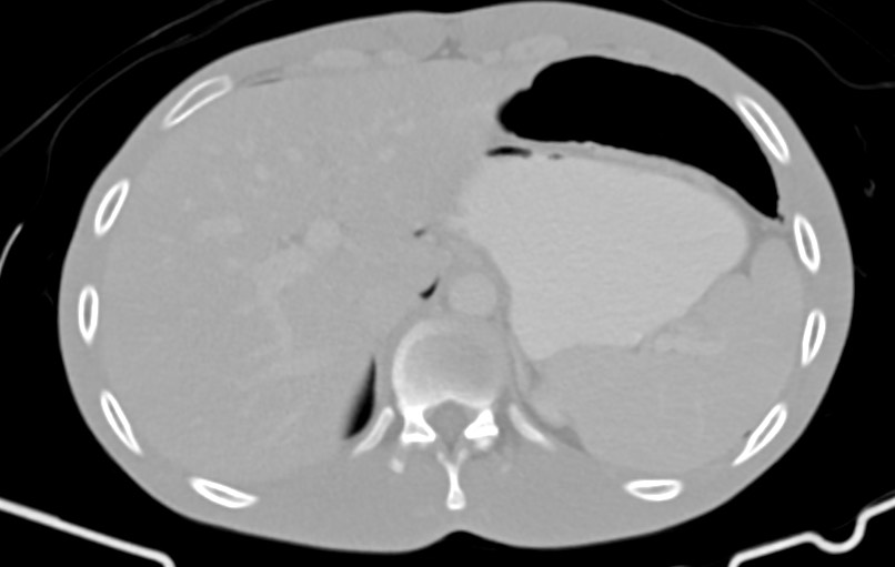 Blunt injury to the small bowel (Radiopaedia 74953-85987 Axial Wide 12).jpg