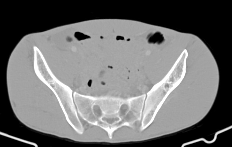 Blunt injury to the small bowel (Radiopaedia 74953-85987 Axial Wide 78).jpg