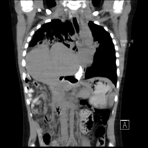 File:Bochdalek diaphragmatic hernia (Radiopaedia 38866-41059 Coronal liver window 11).jpg