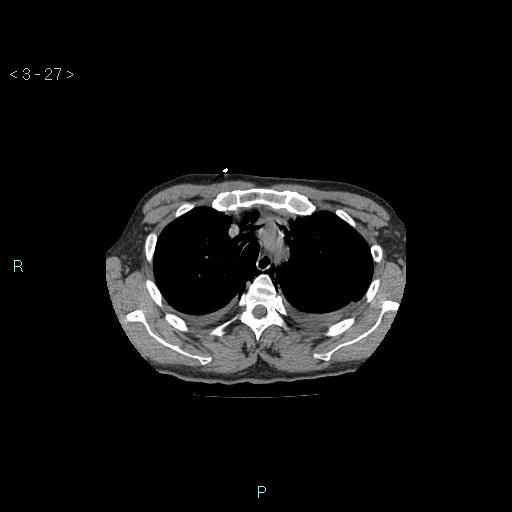 Boerhaave syndrome (Radiopaedia 27683-27897 Axial non-contrast 27).jpg