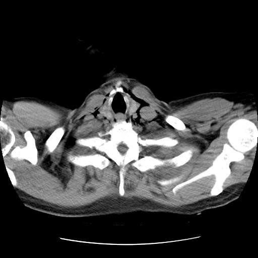 Boerhaave syndrome (Radiopaedia 59796-67310 Axial liver window 7).jpg