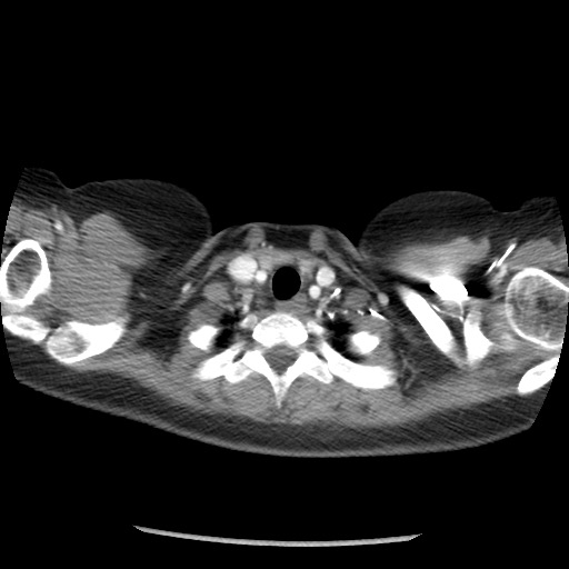Borderline mucinous tumor (ovary) (Radiopaedia 78228-90808 A 4).jpg