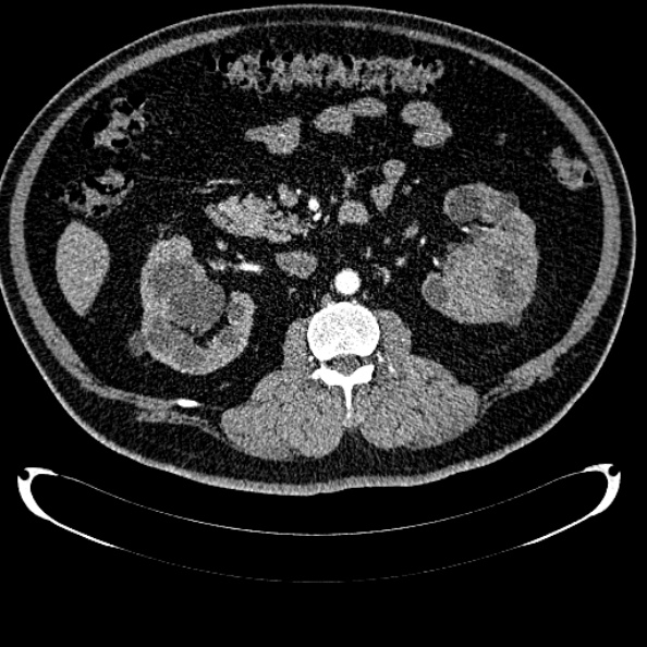 Bosniak renal cyst - type IV (Radiopaedia 24244-24518 B 151).jpg