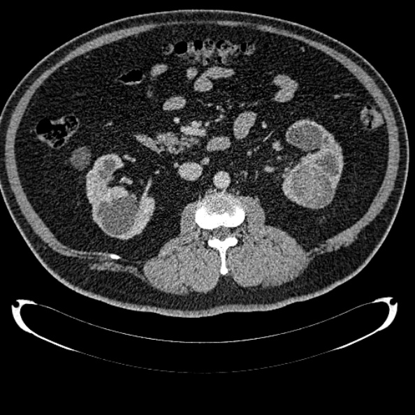Bosniak renal cyst - type IV (Radiopaedia 24244-24518 C 166).jpg