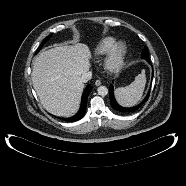 Bosniak renal cyst - type IV (Radiopaedia 24244-24518 C 26).jpg