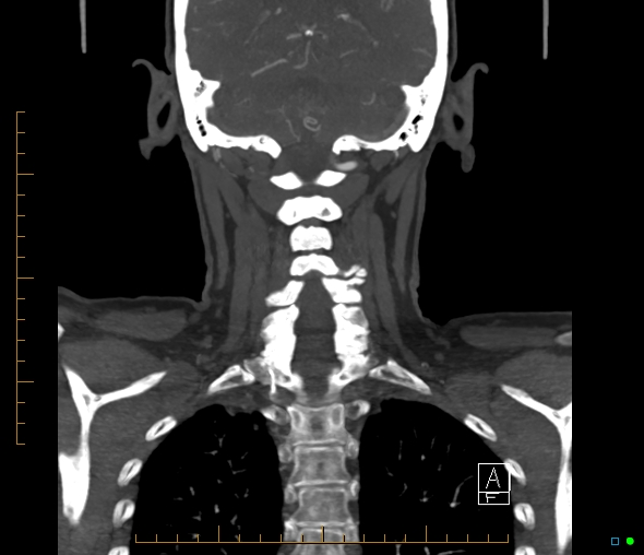 Brachiocephalic trunk stenosis (Radiopaedia 87242-103519 B 53).jpg