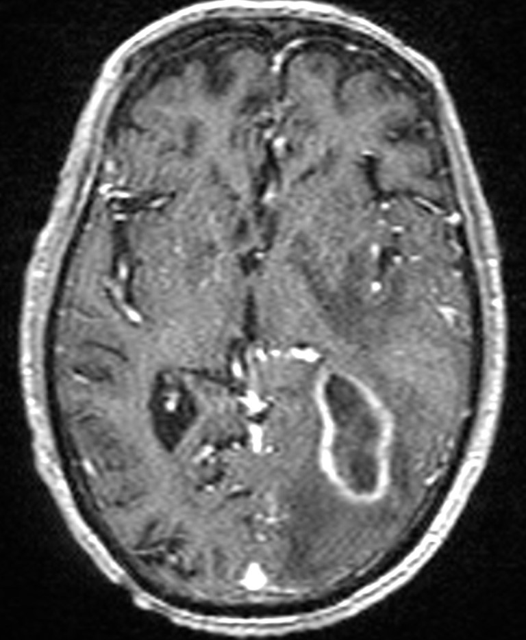 Brain abscess with dual rim sign (Radiopaedia 87566-103938 Axial T1 C+ 84).jpg