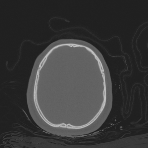 File:Brain contusions, internal carotid artery dissection and base of skull fracture (Radiopaedia 34089-35339 Axial bone window 97).png
