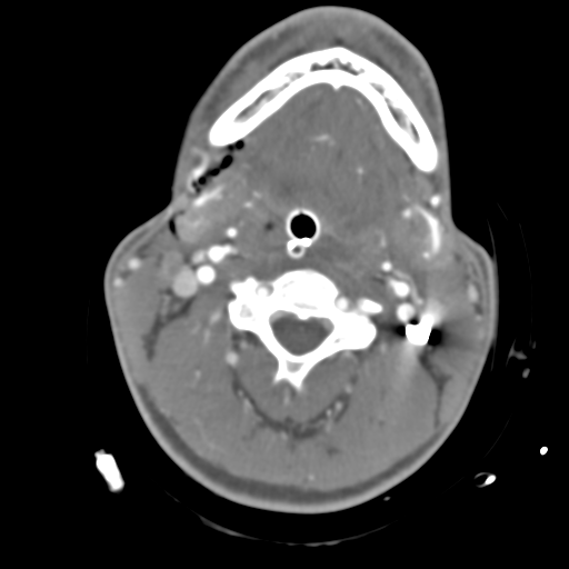 Brain contusions, internal carotid artery dissection and base of skull fracture (Radiopaedia 34089-35339 D 68).png