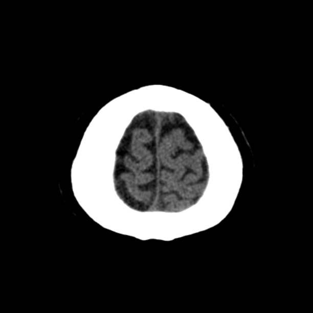 Brain cortical laminar necrosis (Radiopaedia 25822-25971 Axial non-contrast 45).jpg