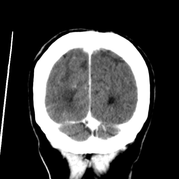 File:Brain metastases from breast cancer (Radiopaedia 23178-23231 D 34).jpg