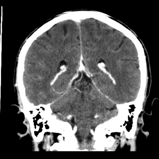 Brain metastases from lung cancer (Radiopaedia 24480-24781 Coronal C+ delayed 41).jpg