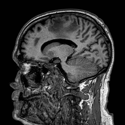 Brain metastases from lung cancer (Radiopaedia 83839-99028 Sagittal T1 77).jpg
