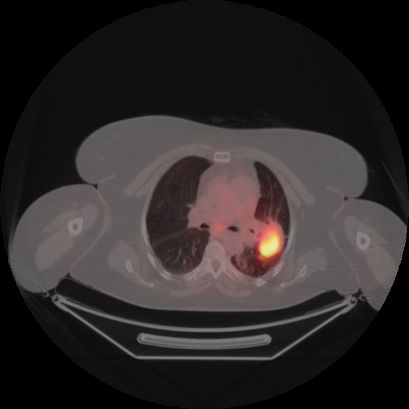 Brain metastasis (Radiopaedia 89847-106962 Axial lung window 23).jpg