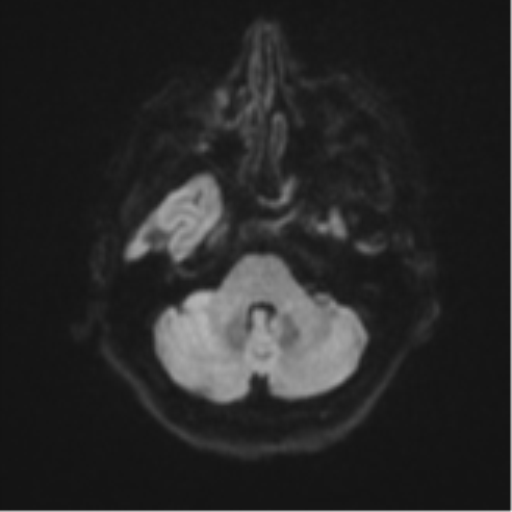 Brain metastasis (sarcoma) (Radiopaedia 47576-52209 Axial DWI 35).png