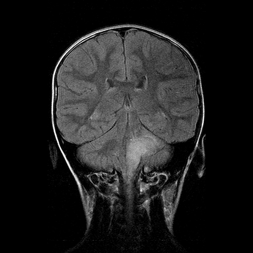 File:Brainstem ganglioglioma (Radiopaedia 10763-11224 Coronal FLAIR 8).jpg