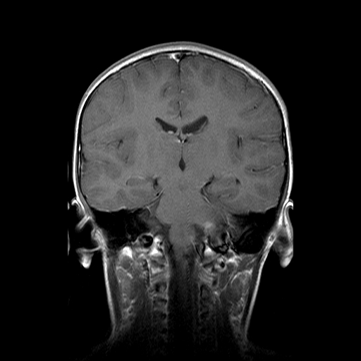 File:Brainstem ganglioglioma (Radiopaedia 10763-11224 Coronal T1 C+ 9).jpg