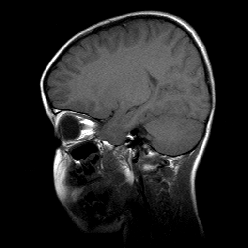 File:Brainstem ganglioglioma (Radiopaedia 10763-11224 Sagittal T1 7).jpg