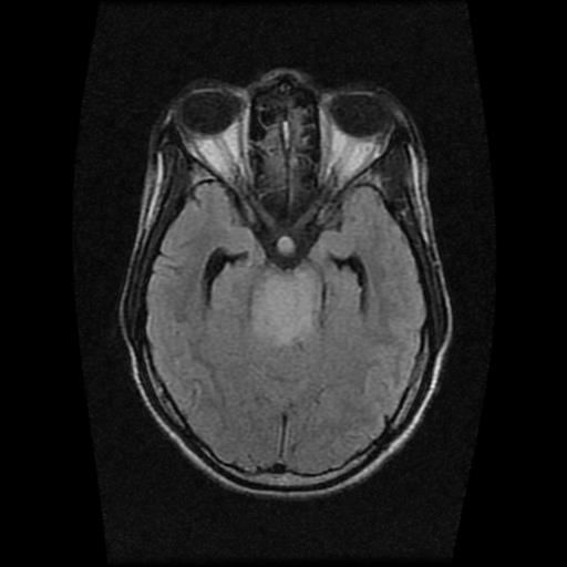File:Brainstem glioma (Radiopaedia 30923-31624 Axial FLAIR 9).jpg