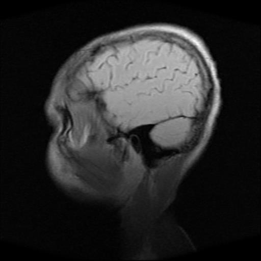 File:Brainstem glioma (Radiopaedia 30923-31624 Sagittal T1 3).jpg
