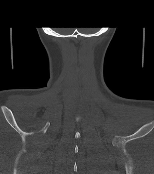 Branchial cleft cyst (Radiopaedia 31167-31875 Coronal bone window 58).jpg