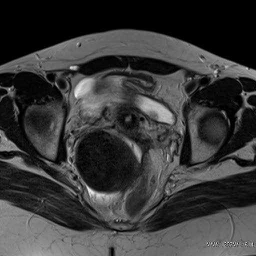 File:Broad ligament fibroid (Radiopaedia 49135-54241 Axial T2 20).jpg