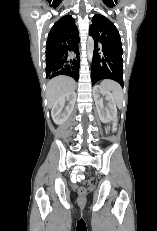Bronchial carcinoid tumor (Radiopaedia 57187-64090 B 84).jpg