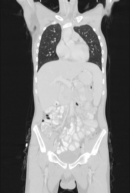Bronchial carcinoid tumor (Radiopaedia 57187-64090 Coronal lung window 33).jpg